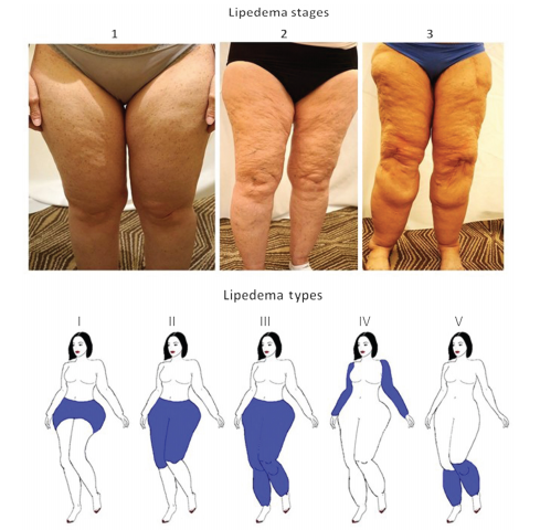 Lipedema Diagnosis, Obesity & BMI