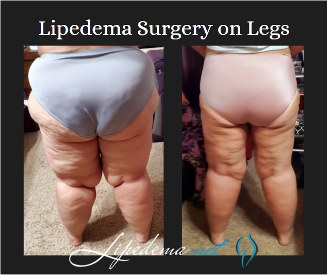 lipedema surgery