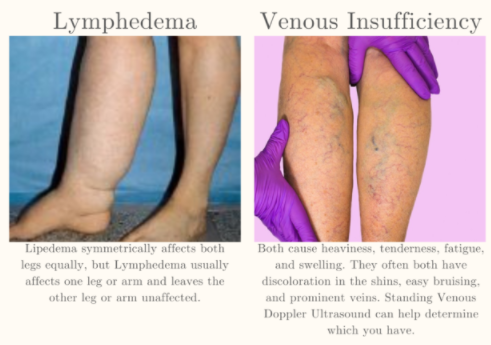 venous insufficiency