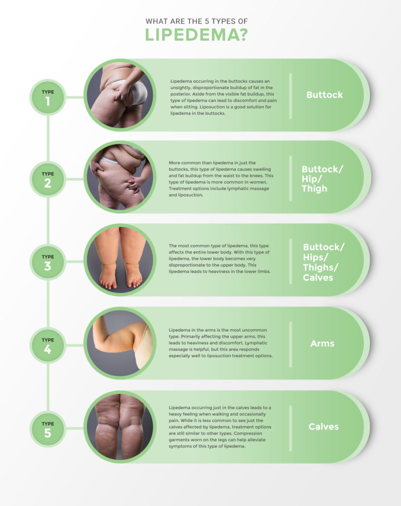 Lipedema Stages