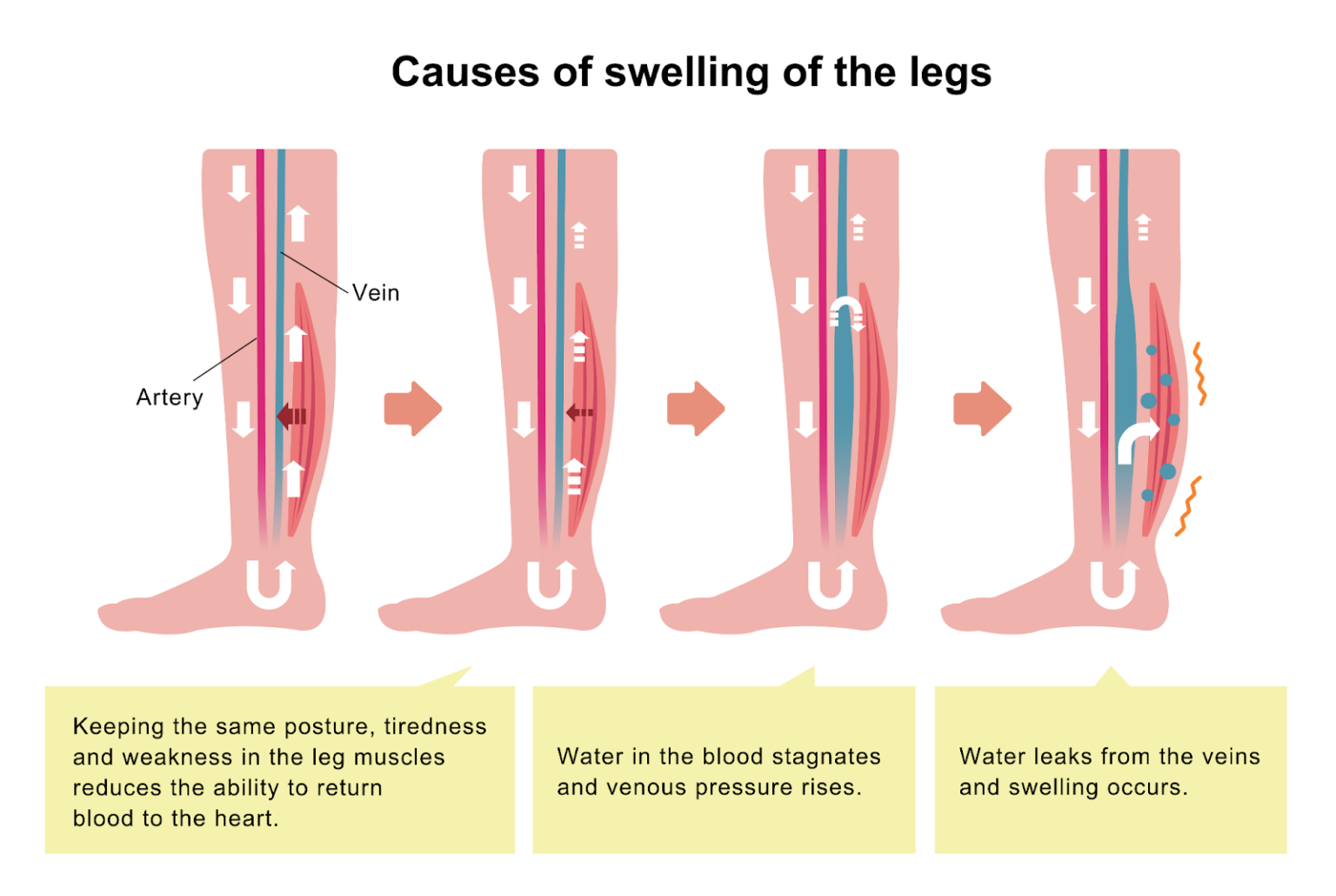 Medical Benefit Of Compression Garments And Compression Therapy Lipedema pregnant-swollen-hands