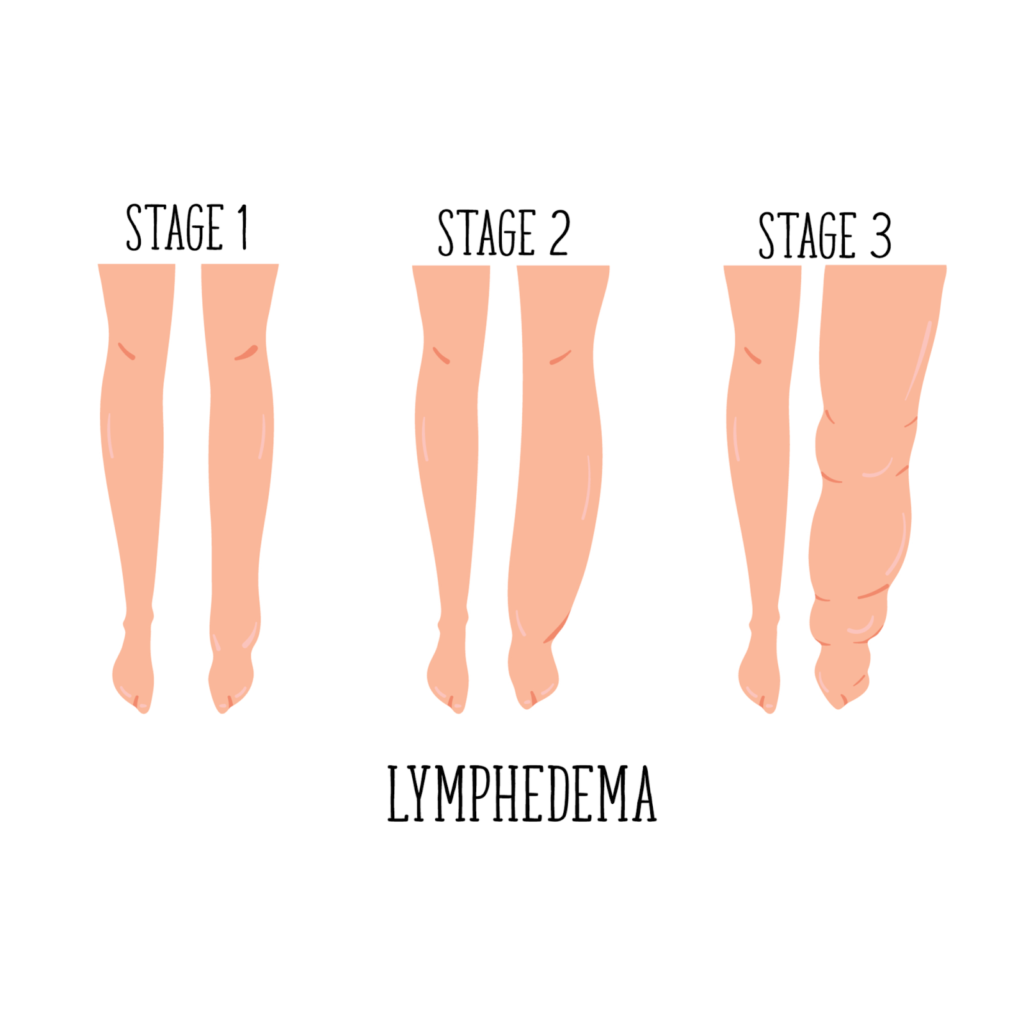 lipedema surgery