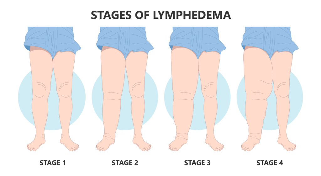 Lymphatic Disease