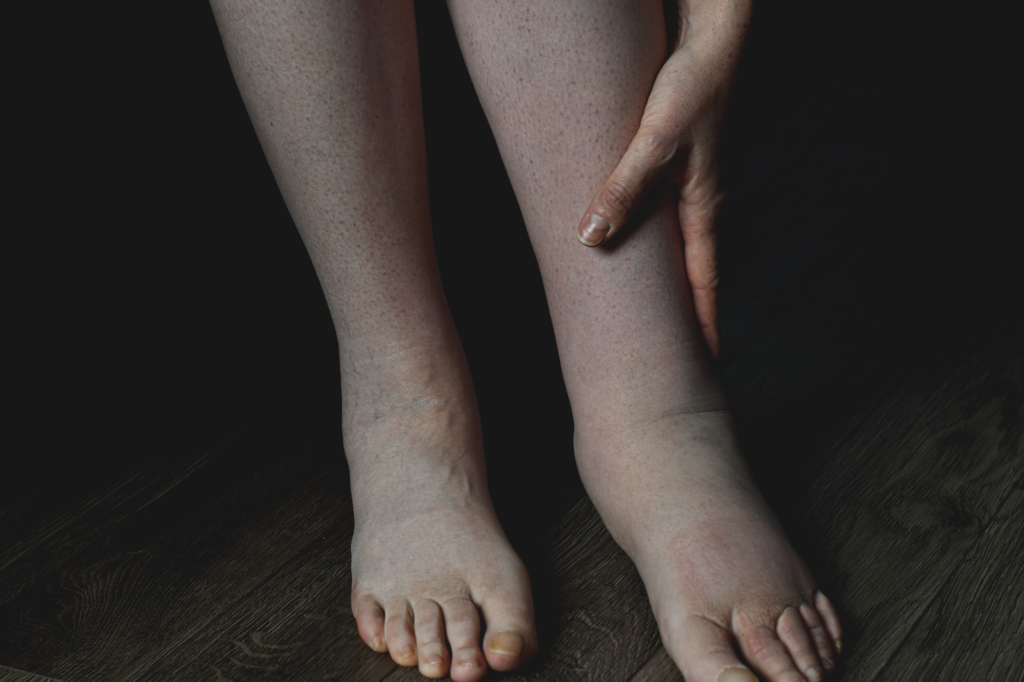 Lymphedema