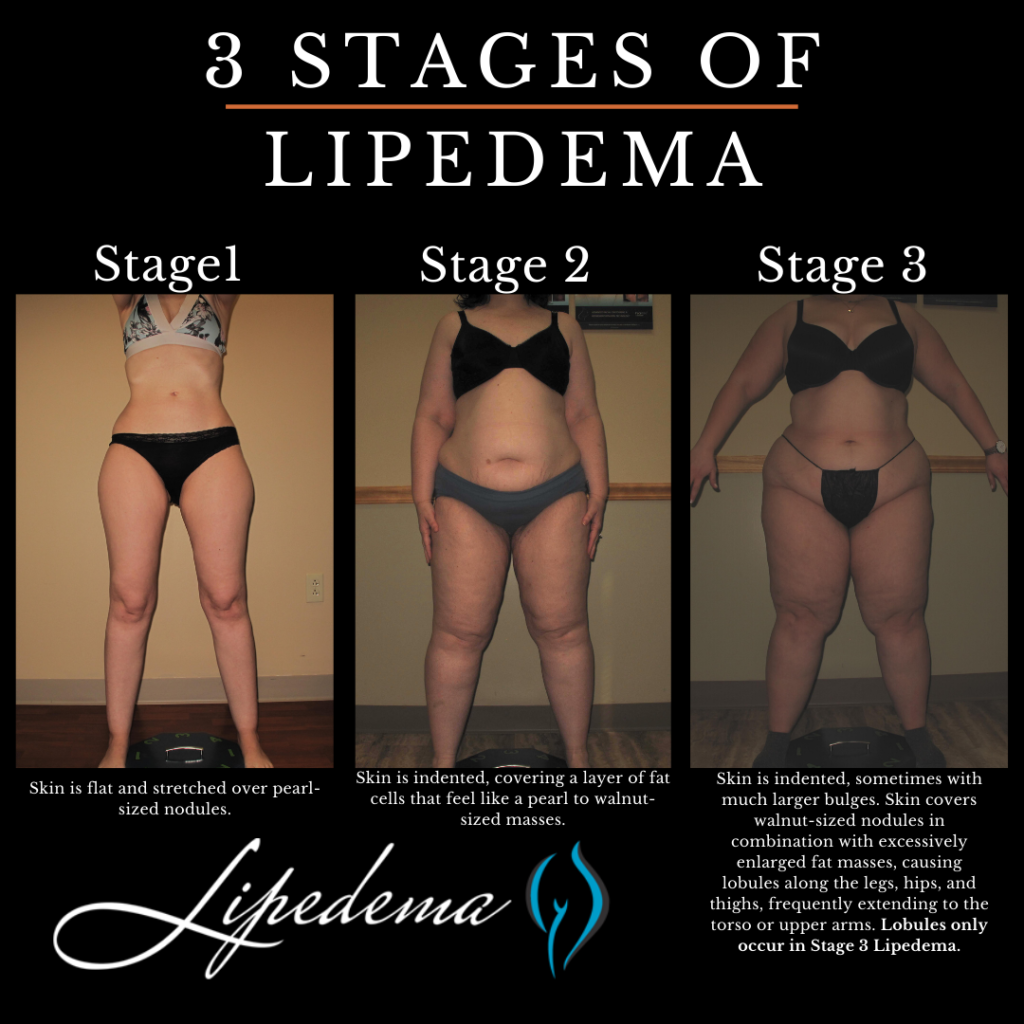 lipedema ankles