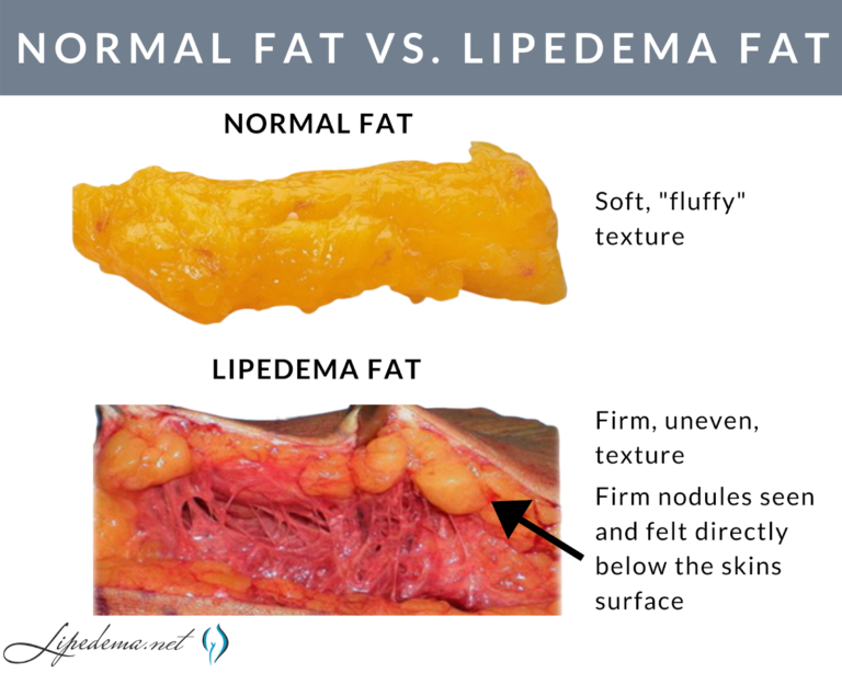 Lipedema Legs