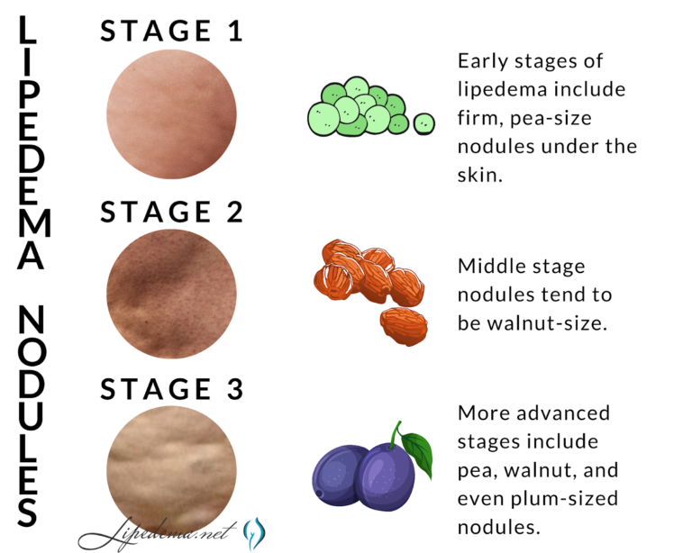 Lipedema diagnosis