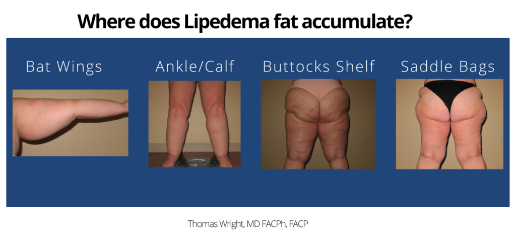 A) Types and (B) stages of lipedema.