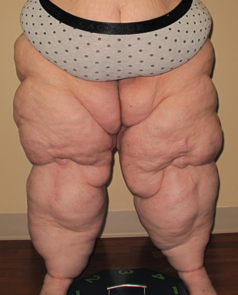 Cause of Lipedema