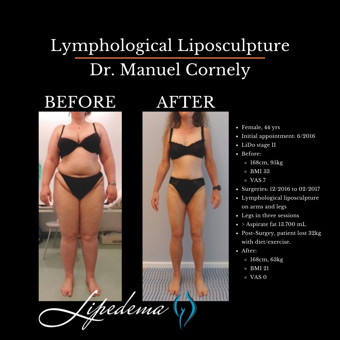 Lipedema Treatment Understanding And Managing This Chronic Condition 