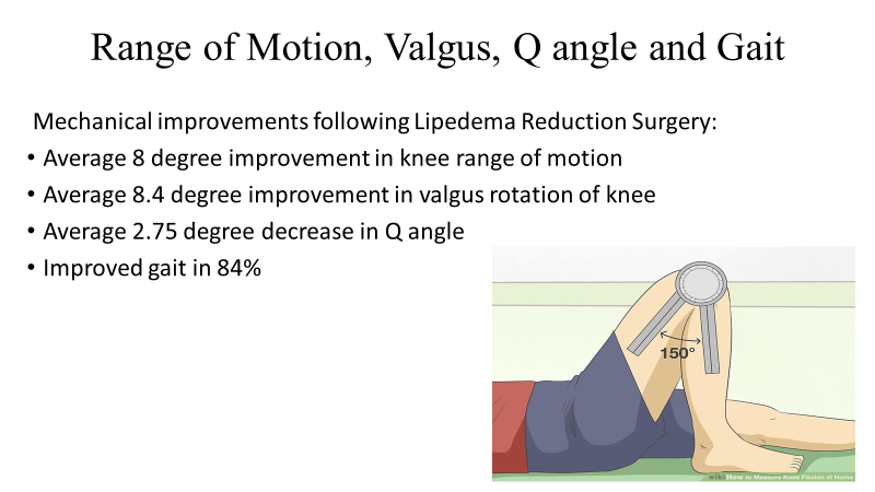 Liposuction Shown to Improve Knee Joint Degeneration