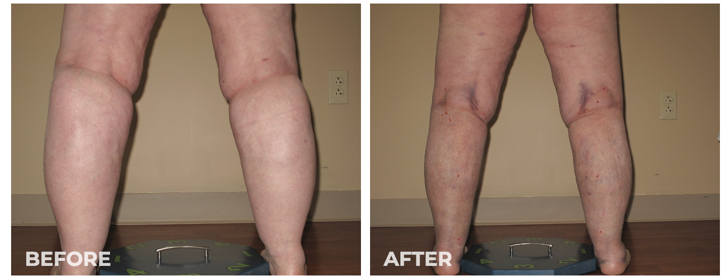 Benefits of Lipedema Lipo for Improved Knee Function