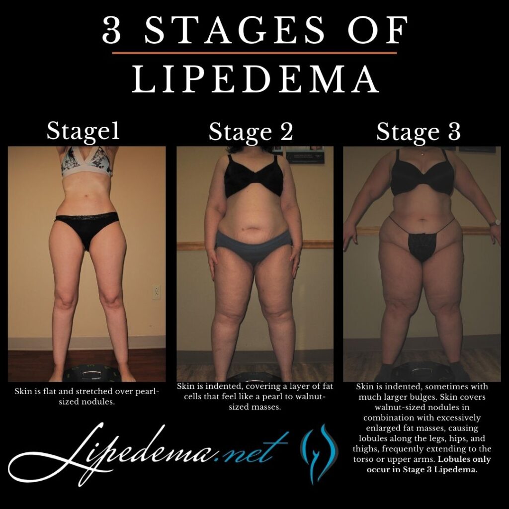 Patient with stage 2 lipedema (A), showing a slight improvement and