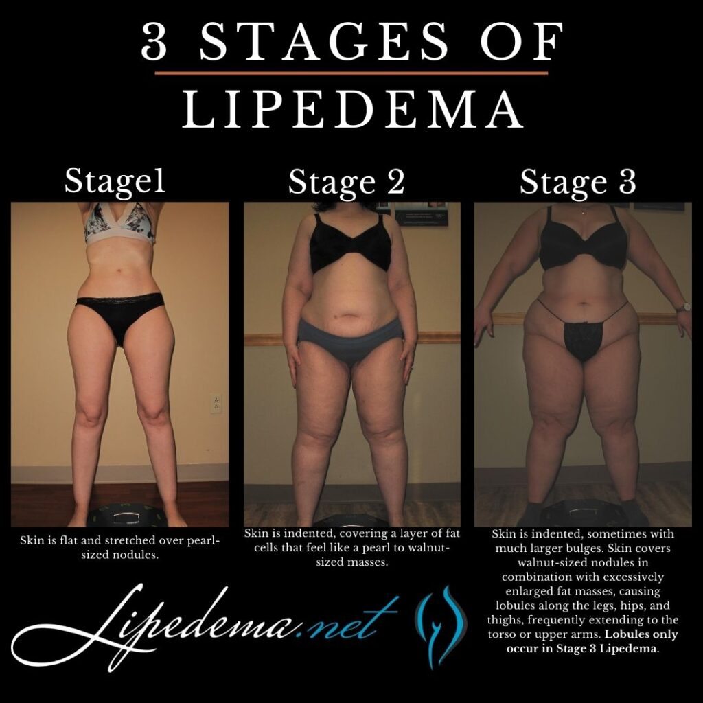 Learn About Stages and Types of Lipedema