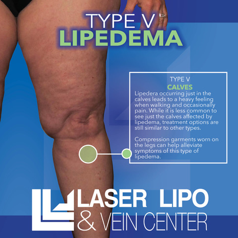 Frequently Asked Questions About Lipedema Progression