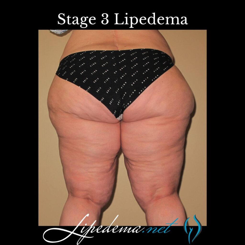 A) Types and (B) stages of lipedema.