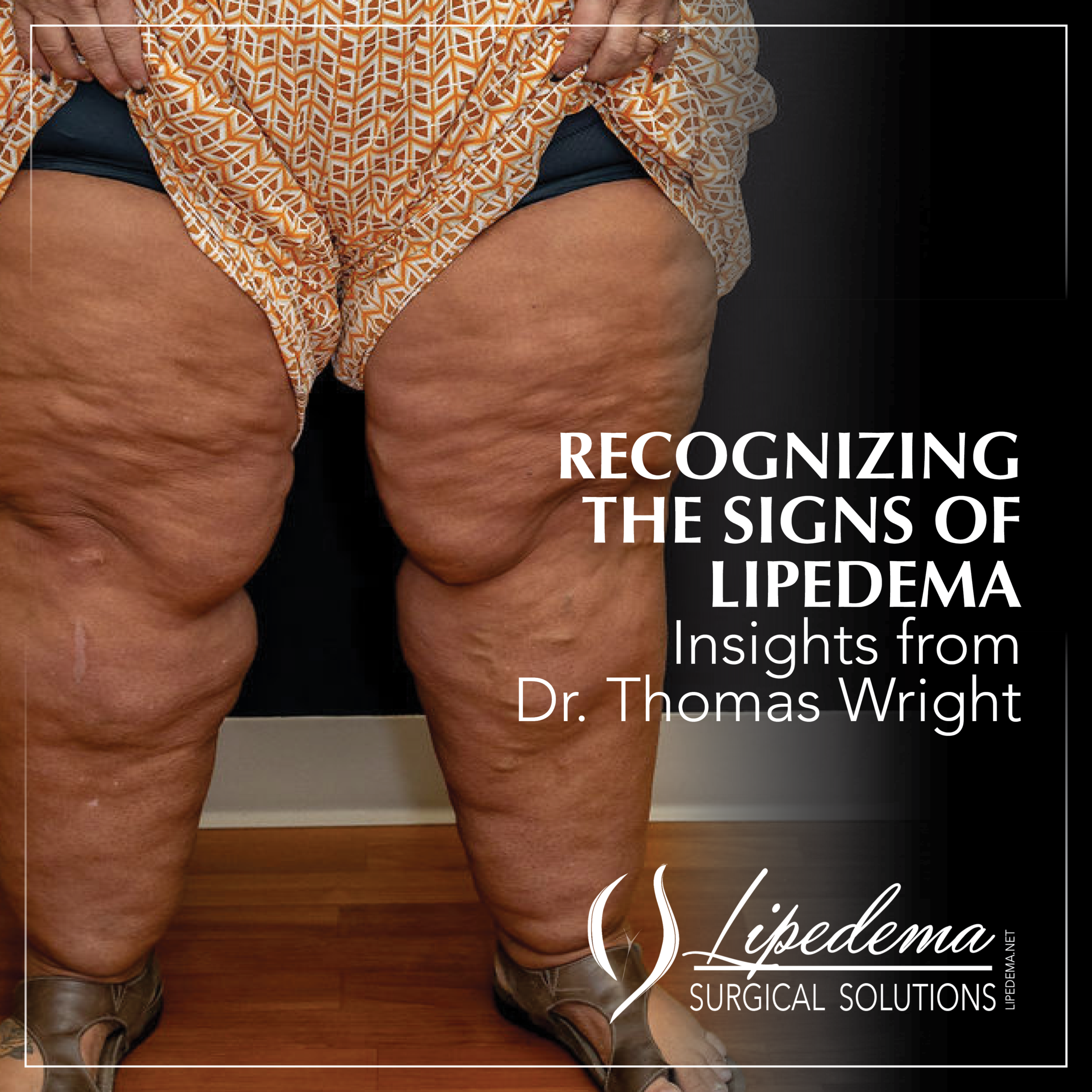 signs of lipedema